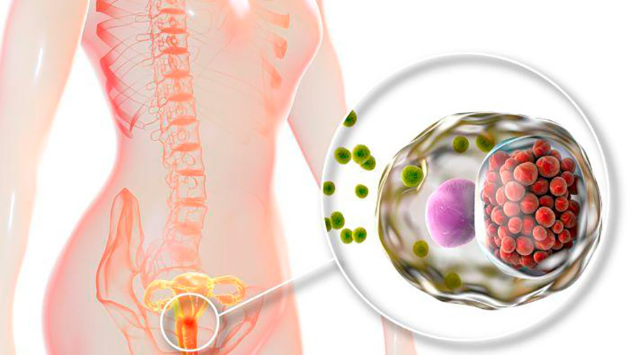 Infecciones vaginales más comunes
